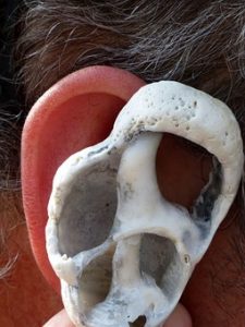 kako odpraviti šumenje v ušesih